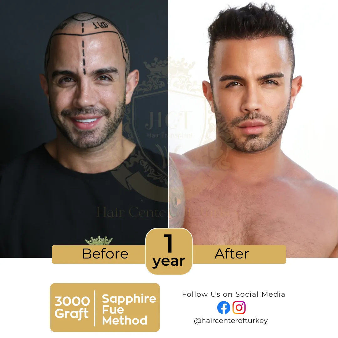 hair transplant before and after images hair center of turkey