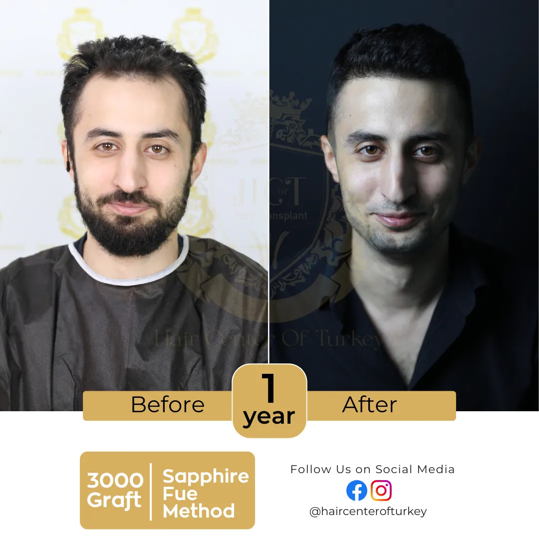 hair transplant before and after images hair center of turkey