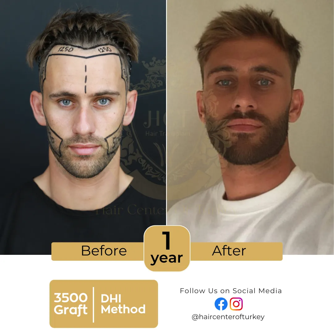 hair transplant before and after images hair center of turkey