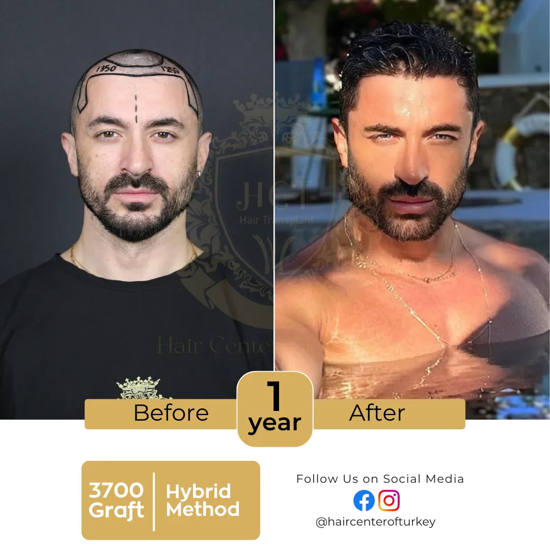 hair transplant before and after images hair center of turkey