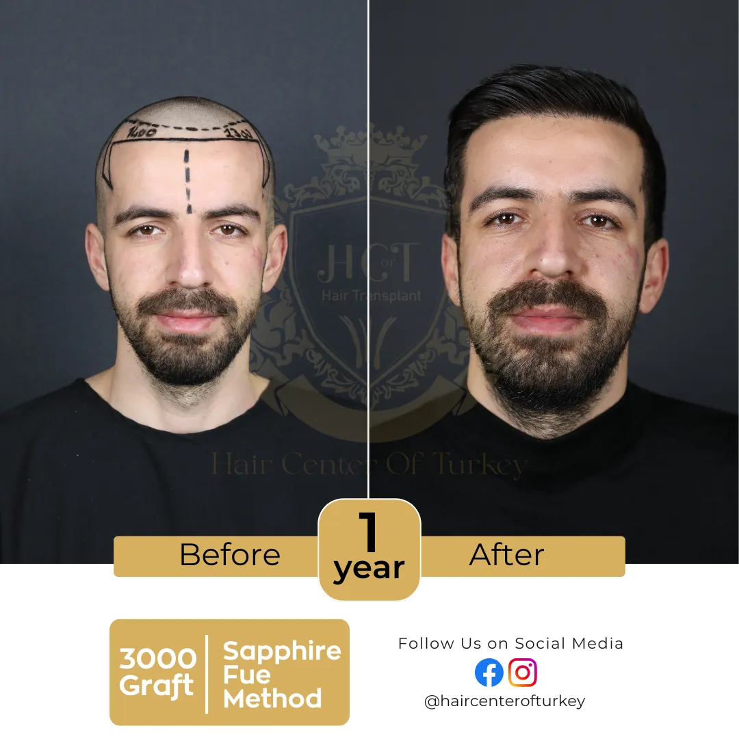 hair transplant before and after images hair center of turkey