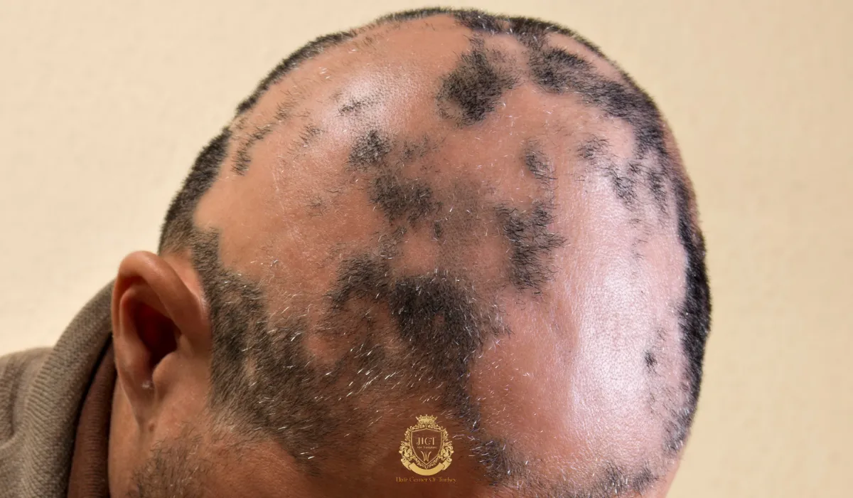 traction alopecia