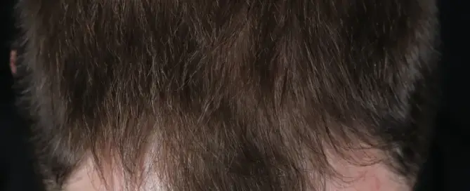 Widow’s Peak Hairline