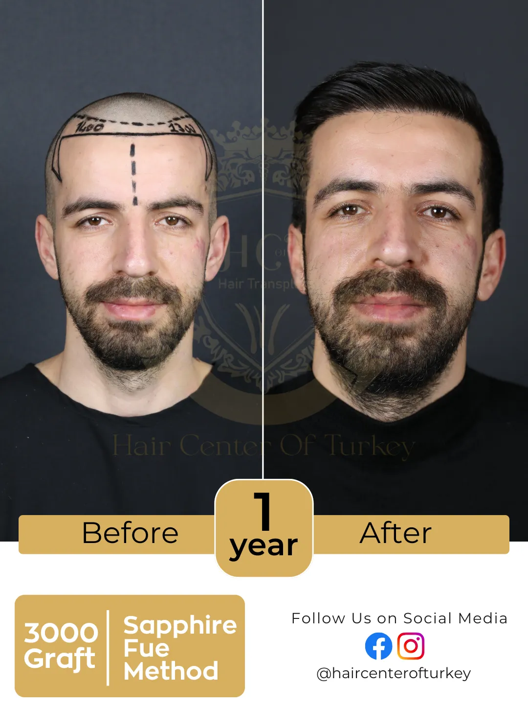 hair transplant before and after images hair center of turkey