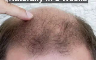 How To Regrow Hair Naturally in 3 Weeks