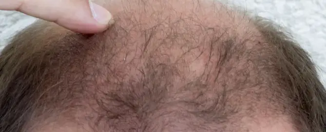 How To Regrow Hair Naturally in 3 Weeks