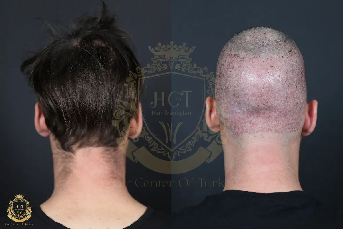 hair transplant gone wrong