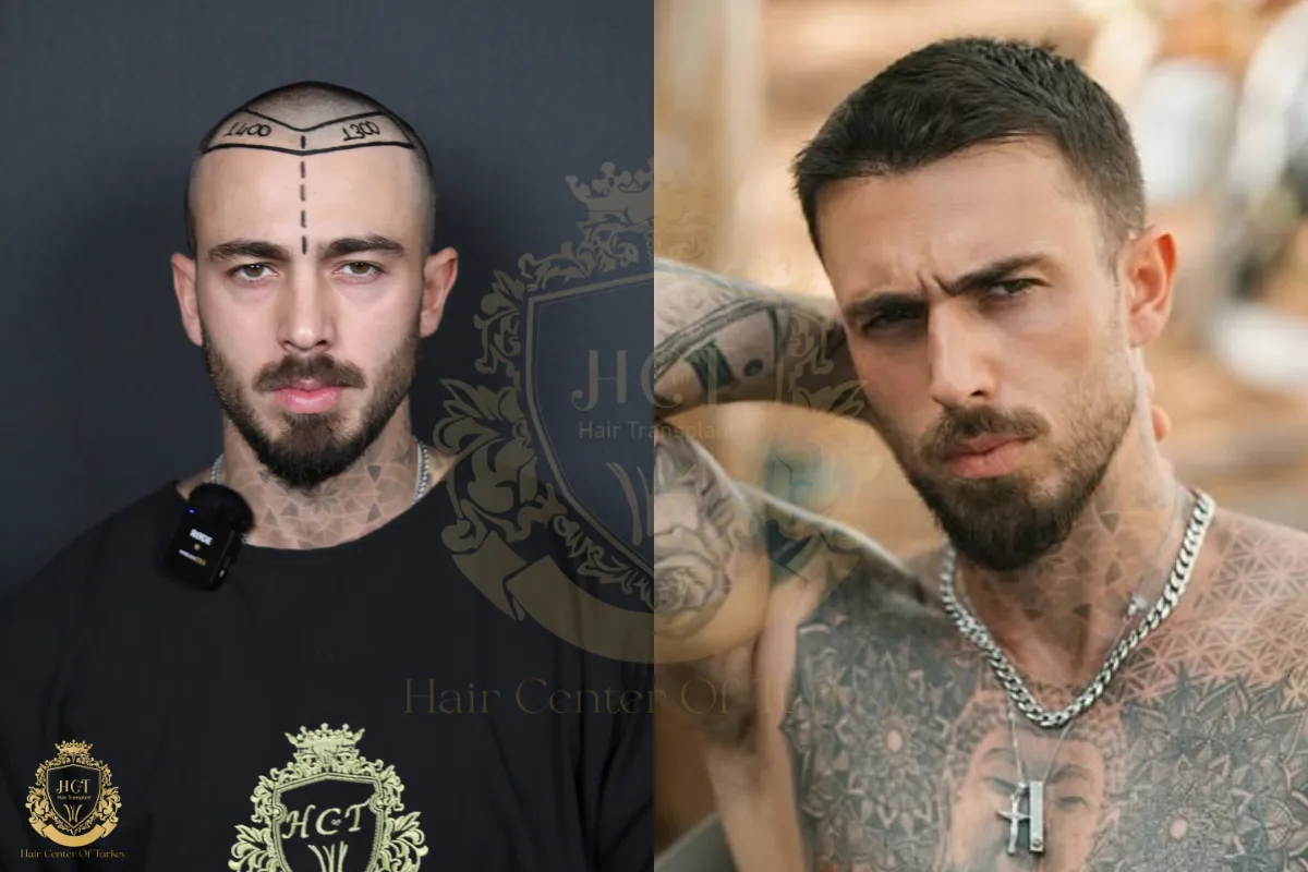 hair transplant gone wrong