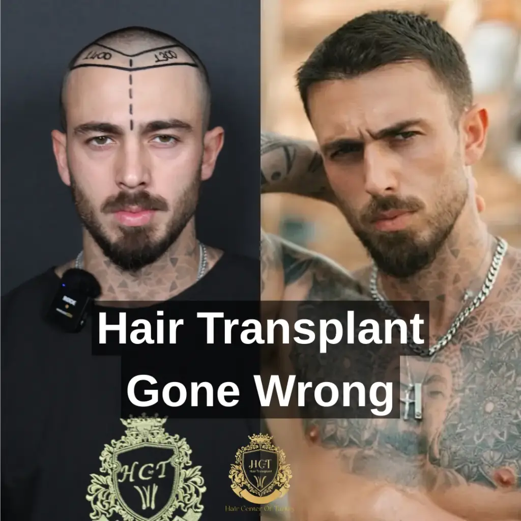 hair transplant gone wrong