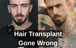 hair transplant gone wrong