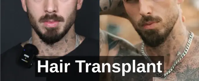 hair transplant gone wrong