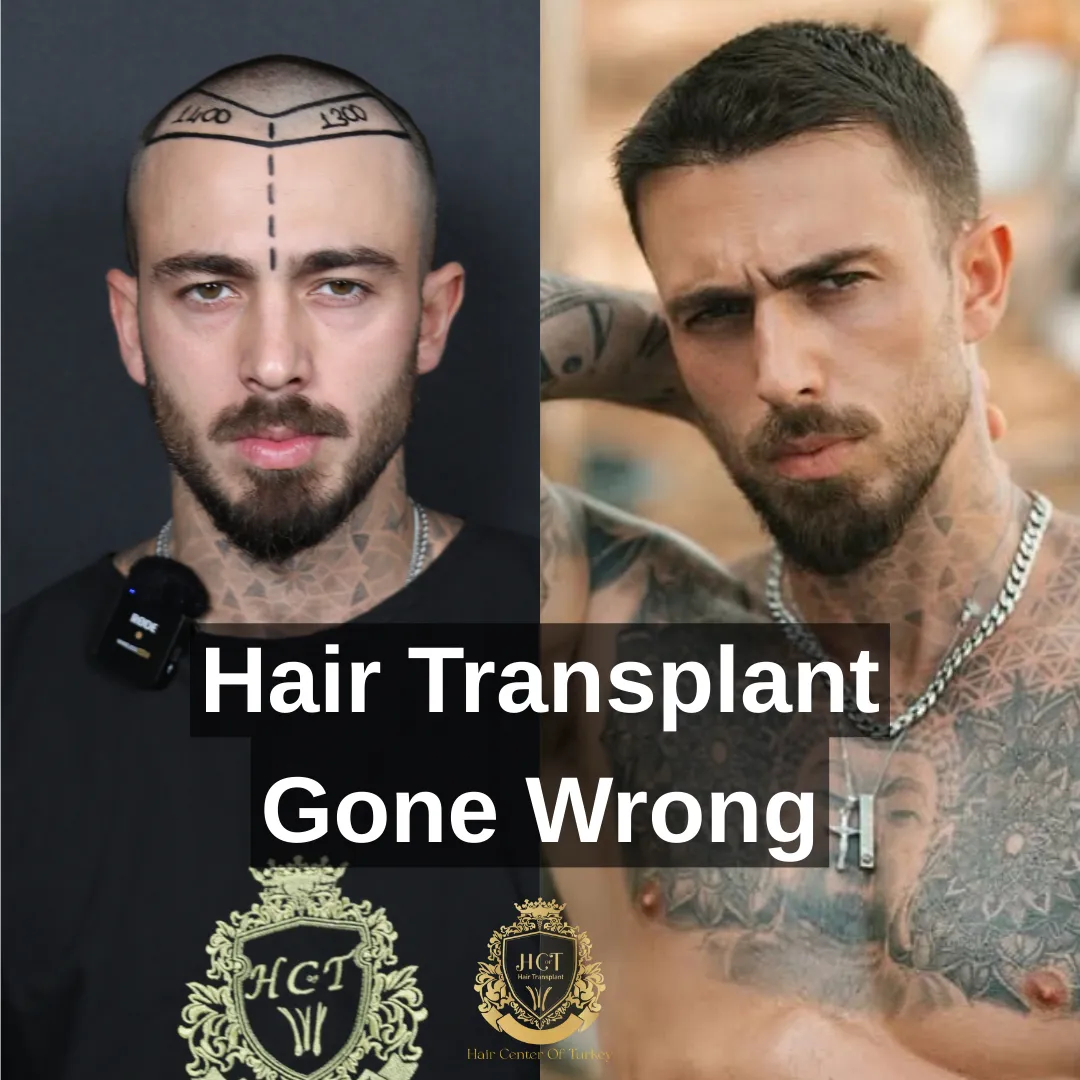 hair transplant gone wrong