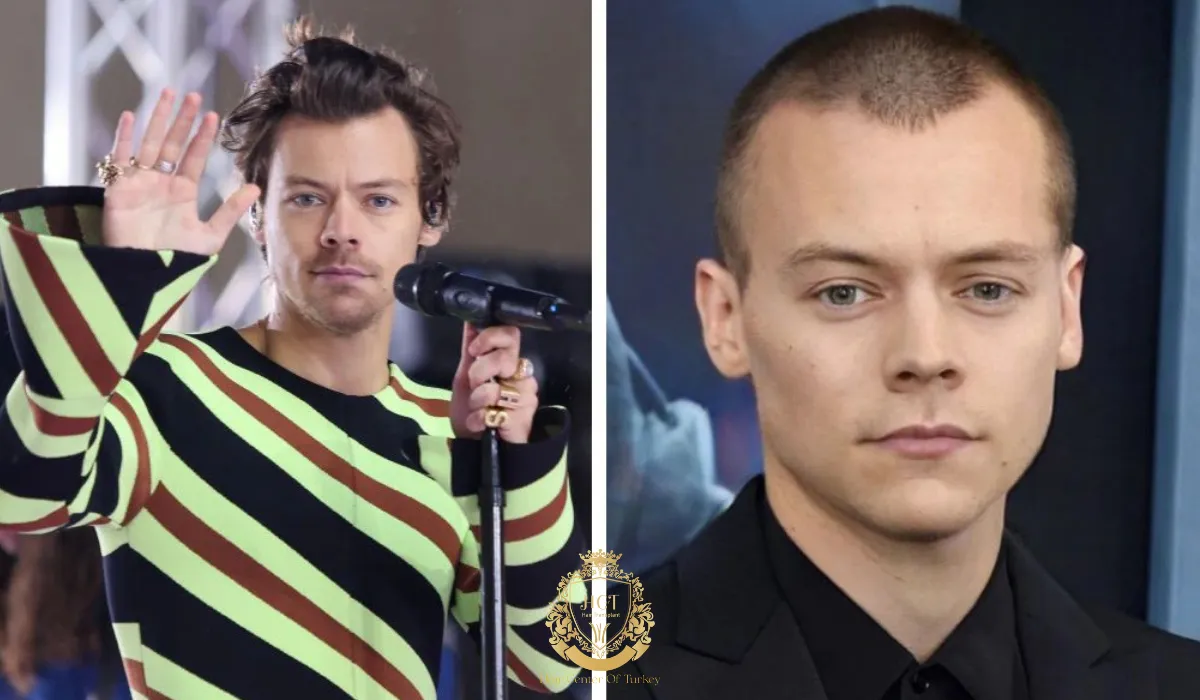 harry styles is bald