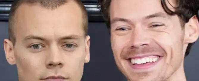 harry styles is bald