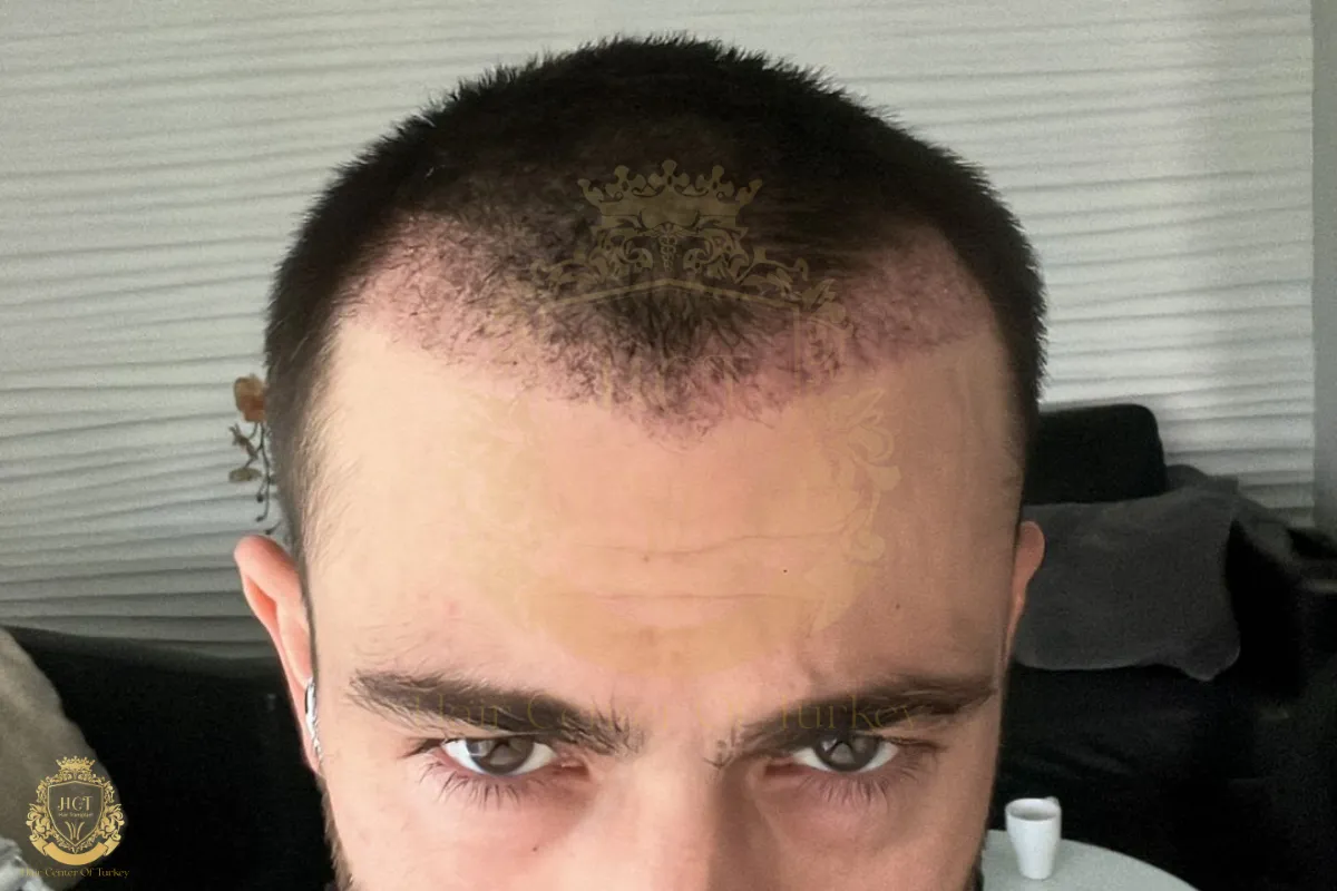 hair transplant gone wrong
