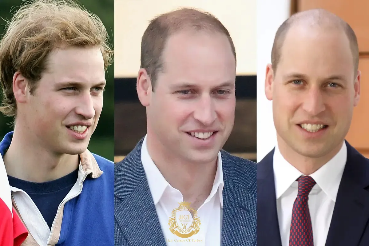 prince william baldness