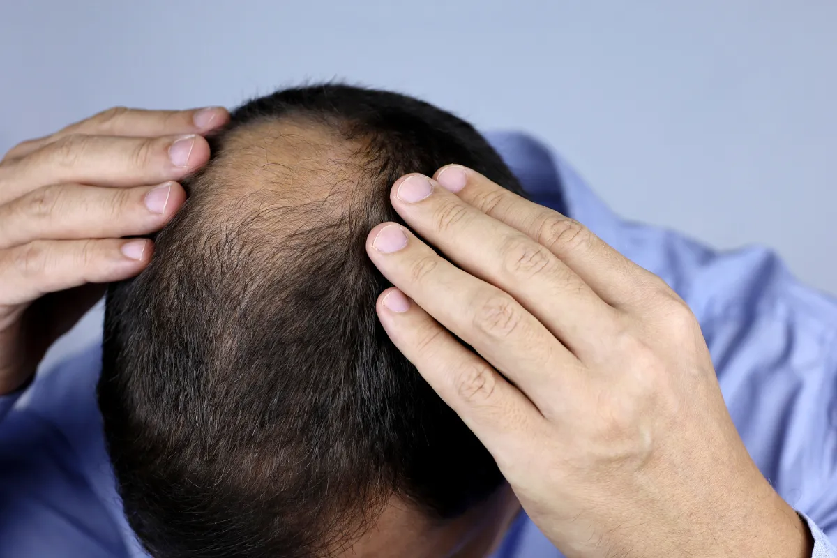 What Happens When a Hair Transplant Fails