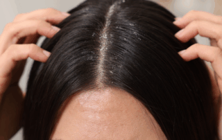 Itchy Scalp