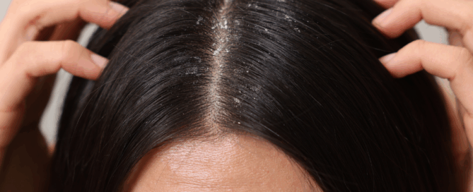 Itchy Scalp