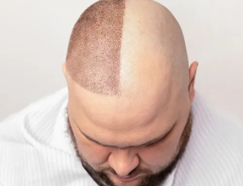 Was passiert, wenn eine Haartransplantation fehlschlägt?