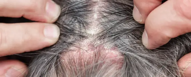 Why Do Hair Roots Hurt