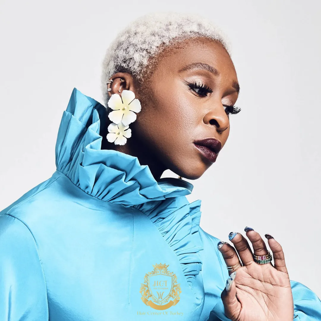 cynthia erivo is bald alopecia