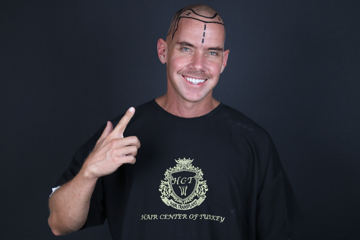 Can Elderly People Get a Hair Transplant?