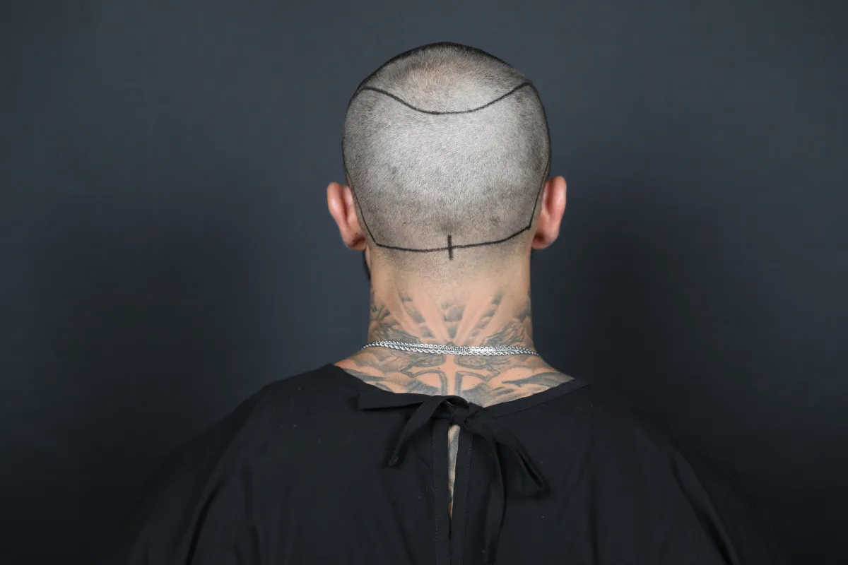 Can People with Thyroid Problems Get a Hair Transplant?