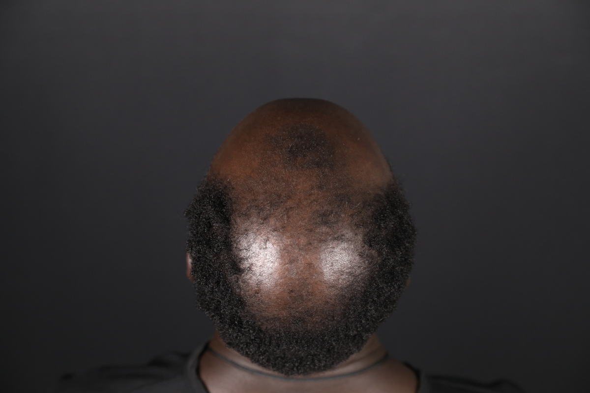 Can Elderly People Get a Hair Transplant?