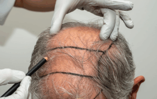 Can Elderly People Get a Hair Transplant?
