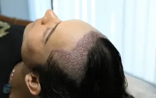 Can Elderly People Get a Hair Transplant?