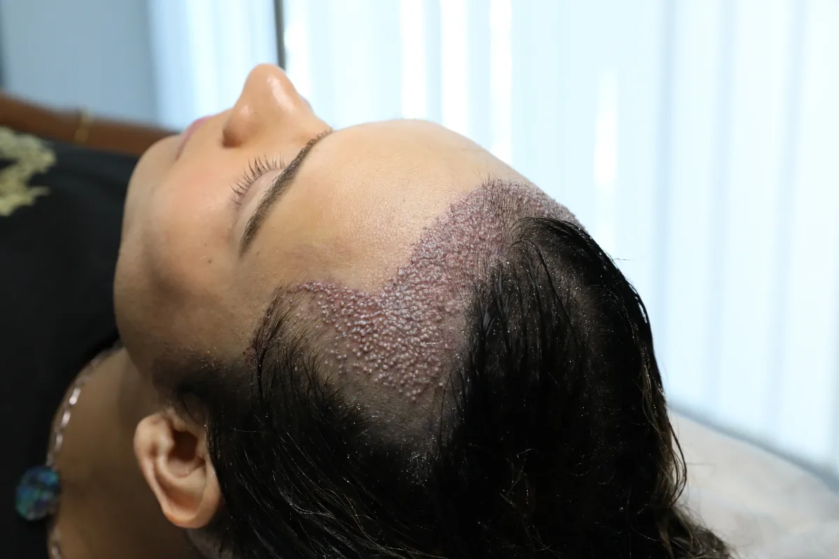Can Elderly People Get a Hair Transplant?