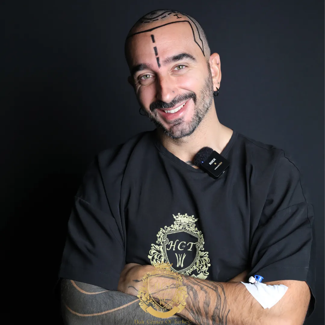 What Are the Possible Complications During a Hair Transplant?