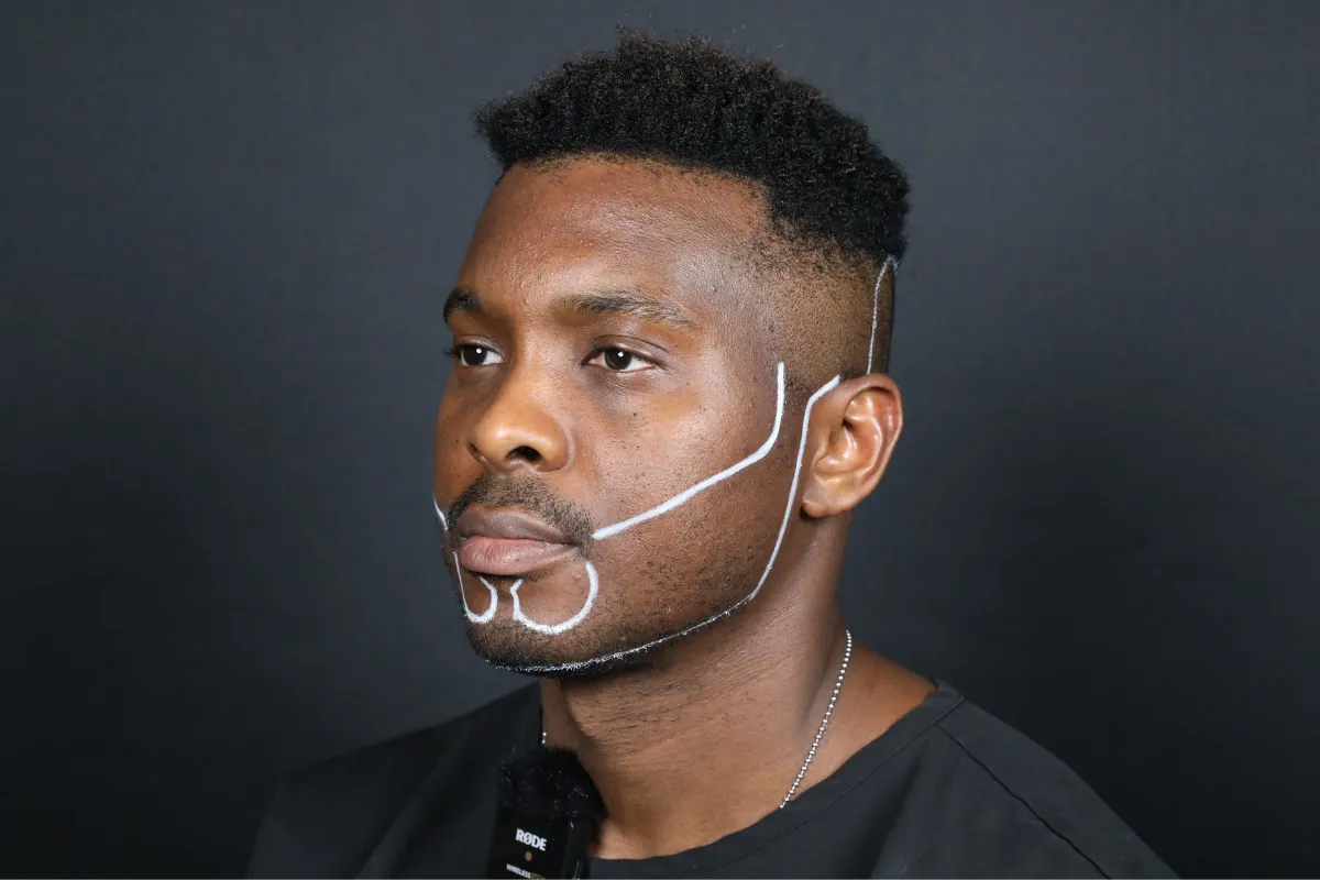 Beard Transplant Design and Planning for Facial Harmony 1