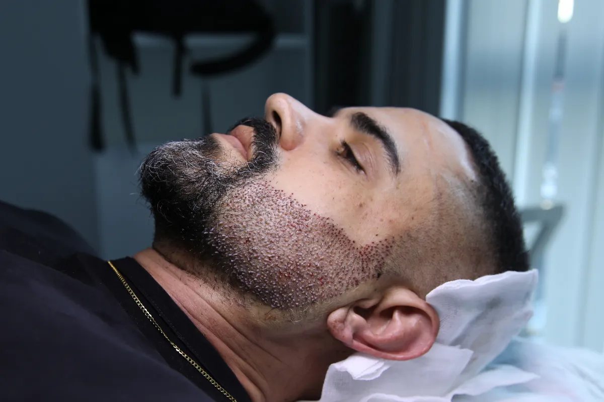 Beard Transplant Design and Planning for Facial Harmony 2