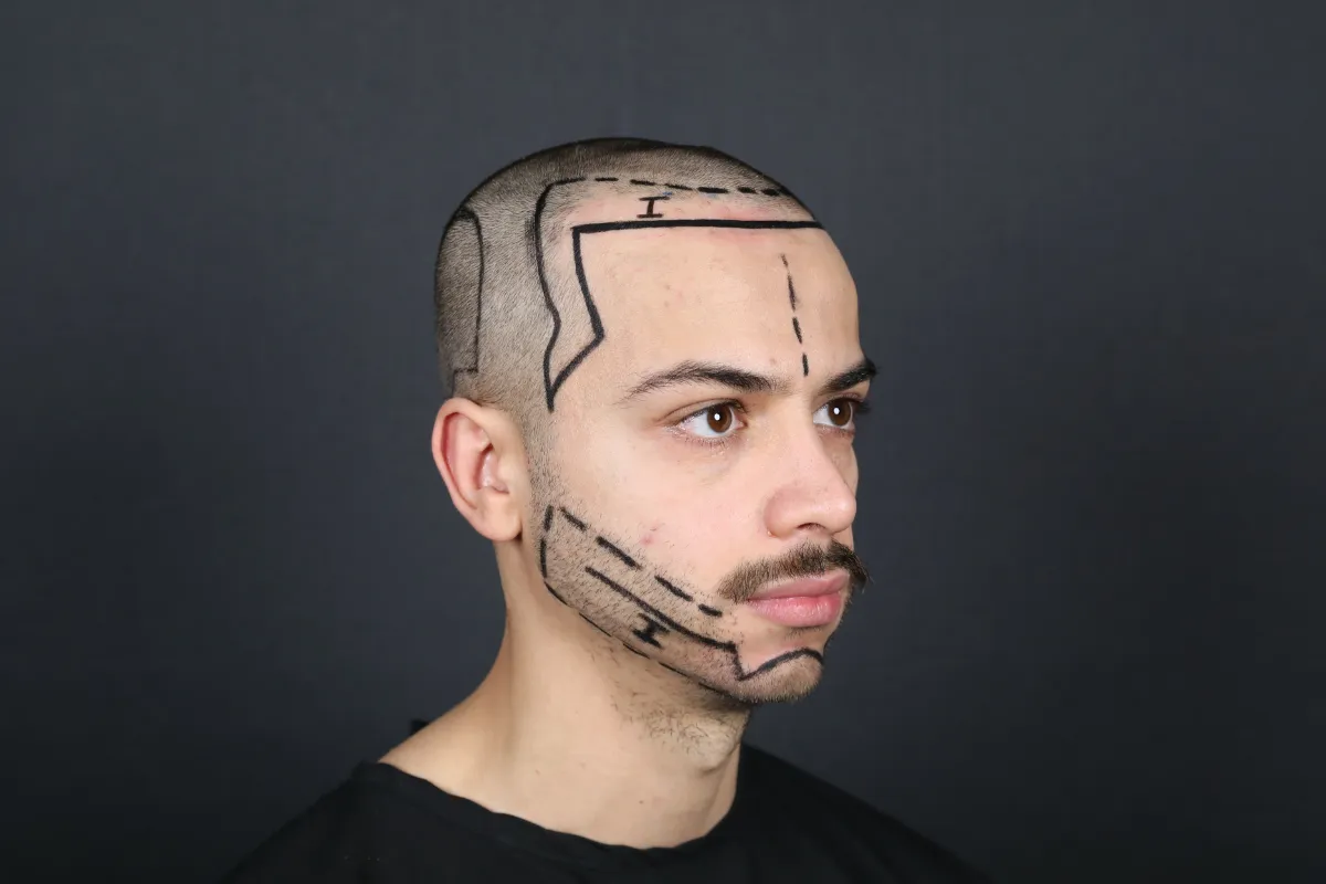DHI vs FUE Beard Transplant Comparison 1