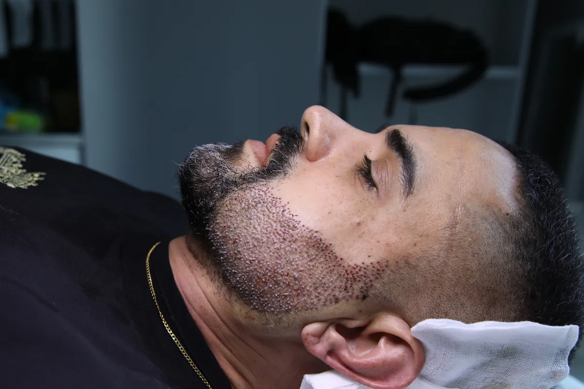 DHI vs FUE Beard Transplant Comparison 2