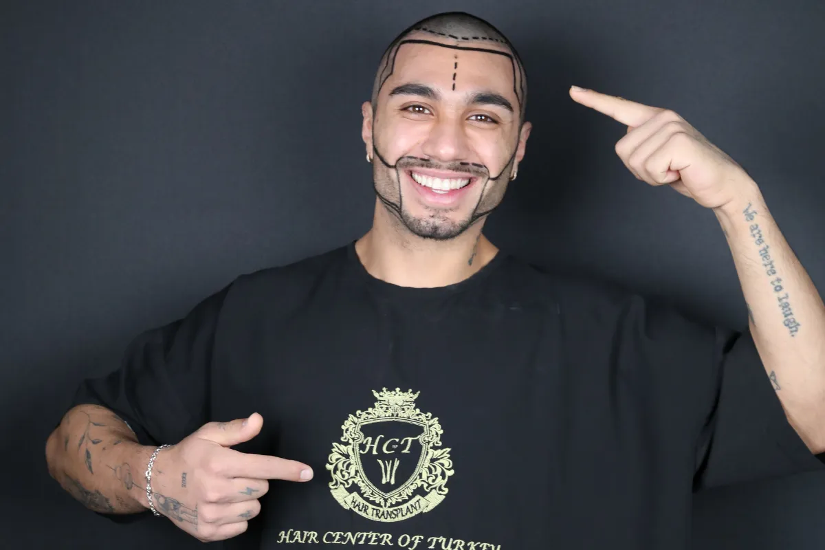 DHI vs FUE Beard Transplant Comparison 3