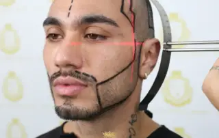 DHI vs FUE Beard Transplant Comparison F
