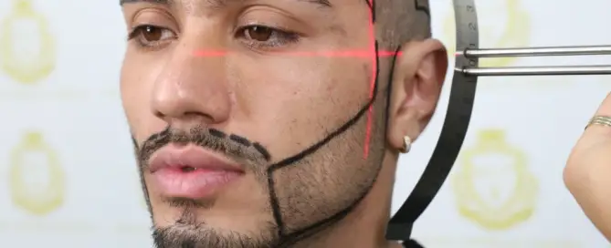 DHI-vs-FUE-Beard-Transplant-Comparison-F