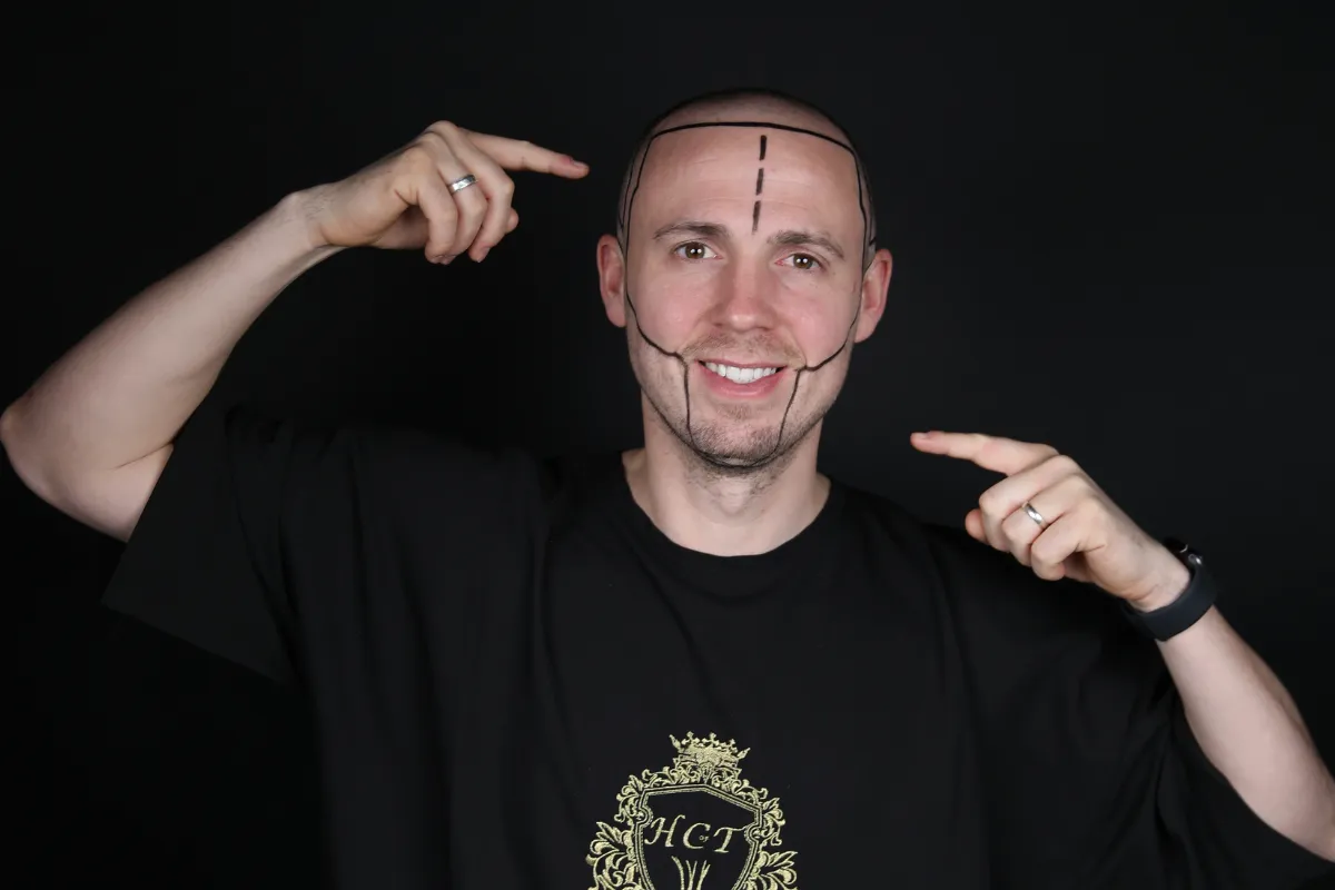 Ideal Candidates for Beard Transplantation 1