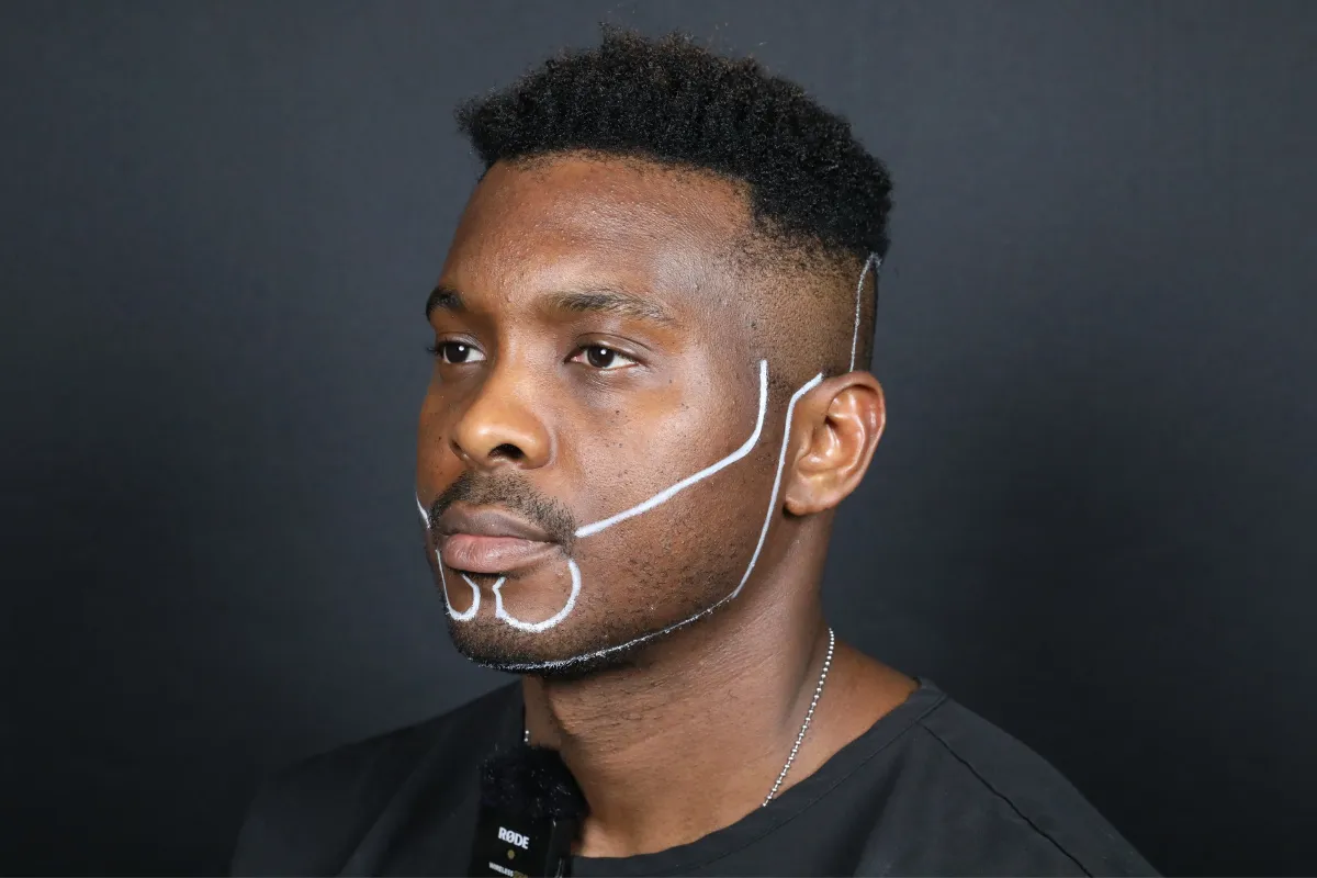 Ideal Candidates for Beard Transplantation 2