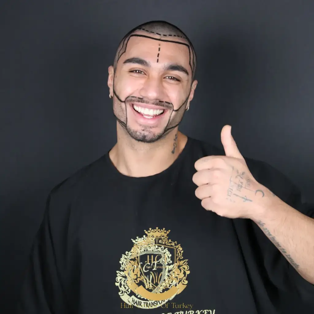 Ideal Candidates for Beard Transplantation F