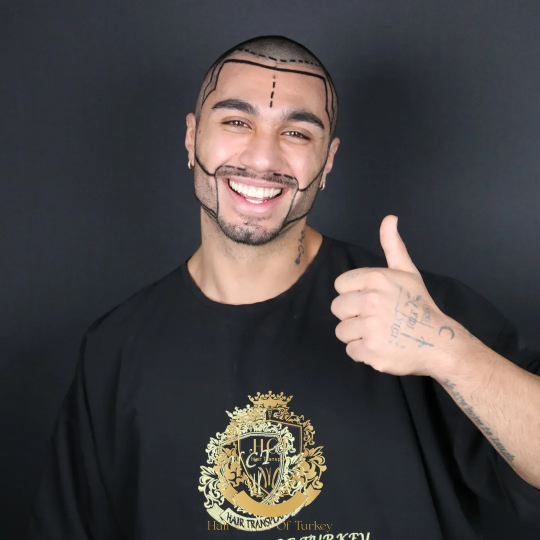 Ideal Candidates for Beard Transplantation F