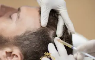 PRP Treatment Combined with Hair Transplantation