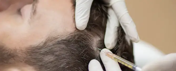 PRP Treatment Combined with Hair Transplantation