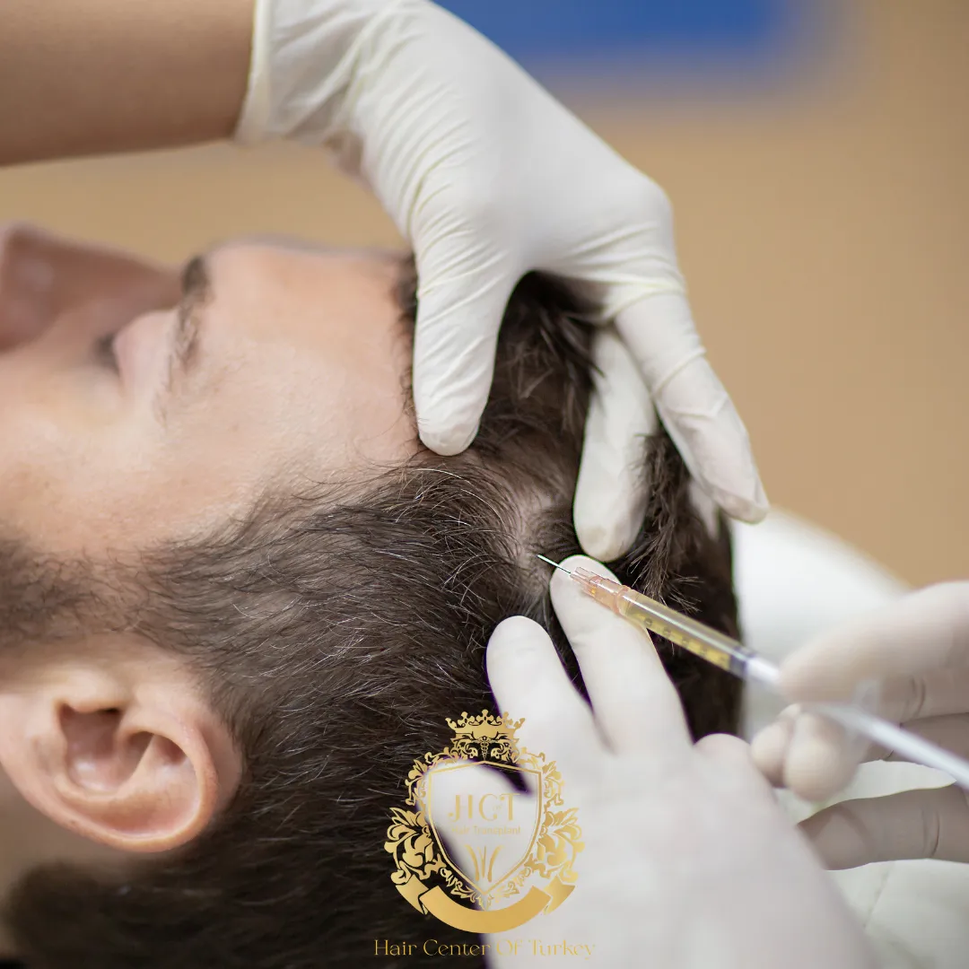 PRP Treatment Combined with Hair Transplantation