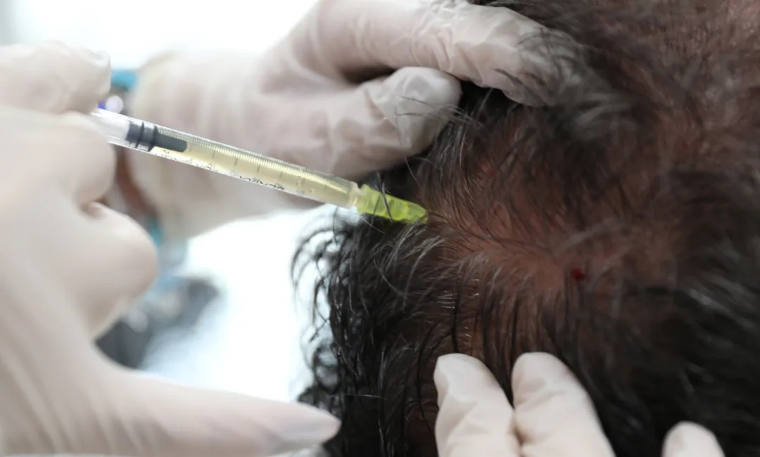 mesotherapy treatment for hair
