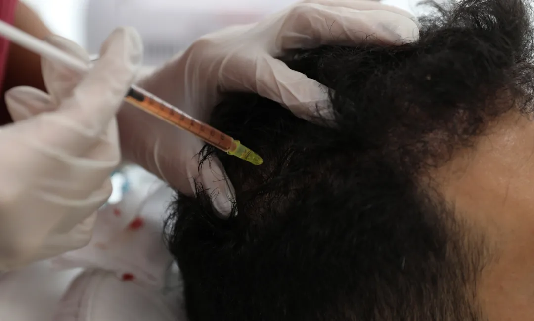 prp treatment for hair