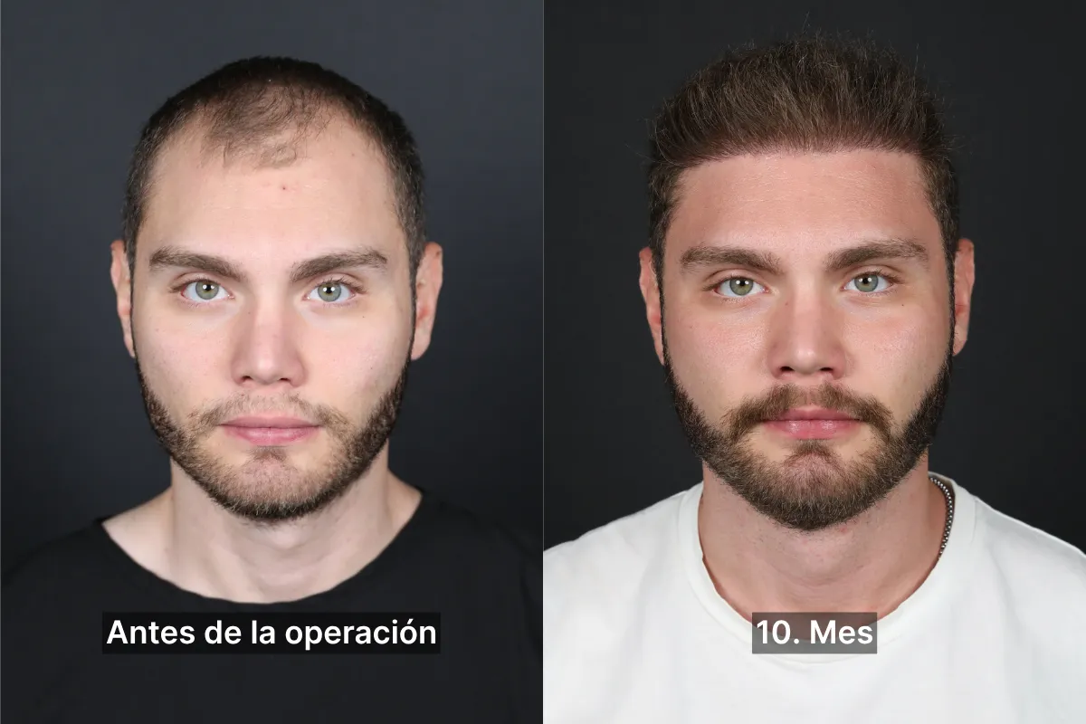 10ay1es